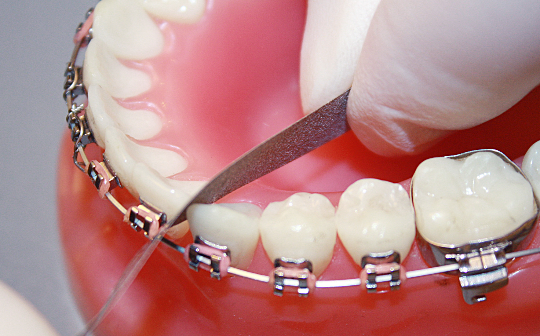 Zahnschmelzreduzierung zur Beseitigung von Engständen Zahnschmelzreduzierung zur Beseitigung von Engständen