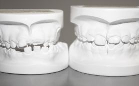 Behandlungsmodelle eines Kindes vor und nach der Behandlung