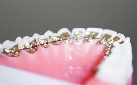 Brackets an der Innenseite des Zahnes