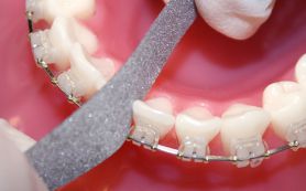 Zahnschmelzreduzierung zur Beseitigung von Engständen