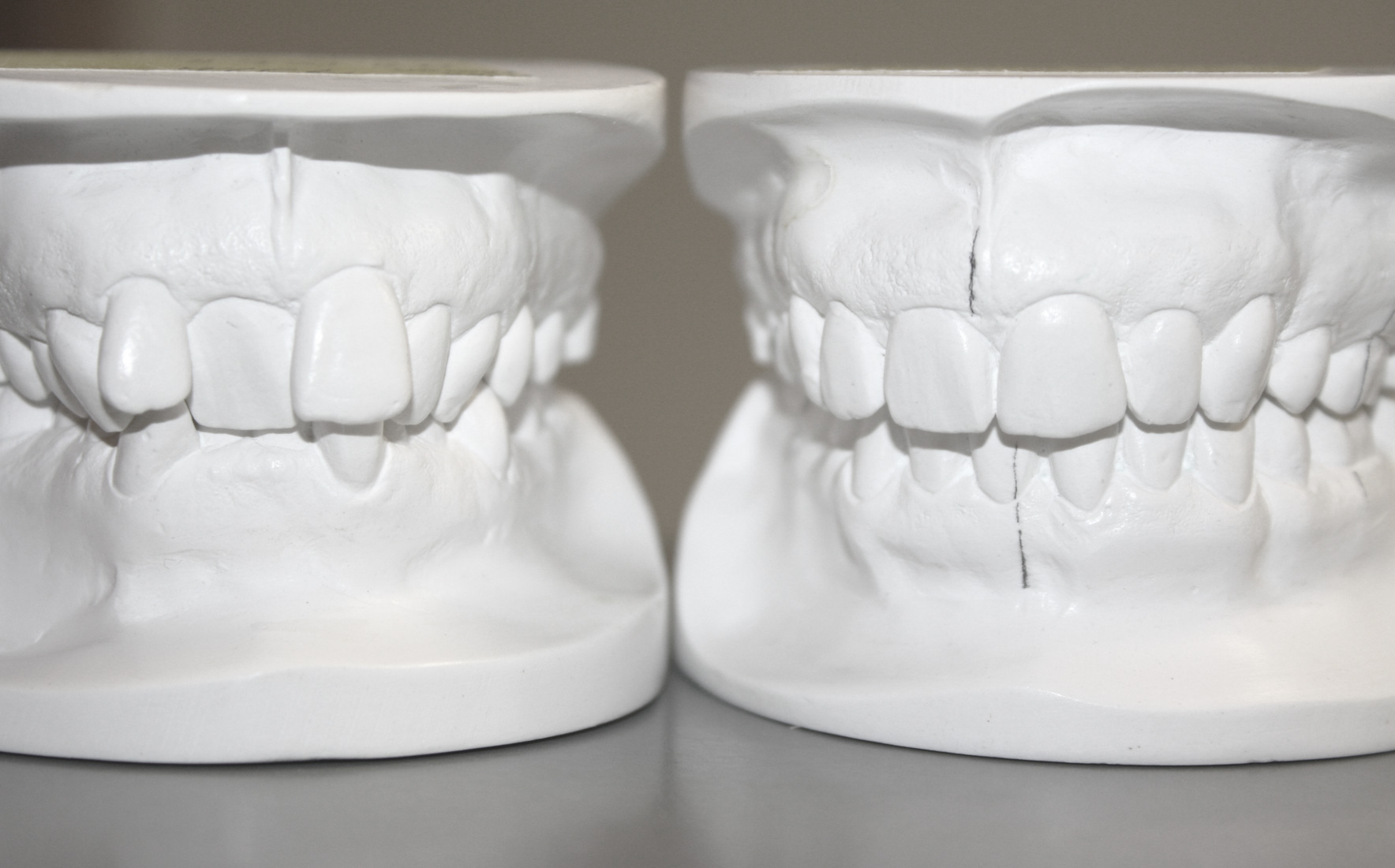 Behandlungsmodelle eines Erwachsenen vor und nach der Behandlung Behandlungsmodelle eines Erwachsenen vor und nach der Behandlung