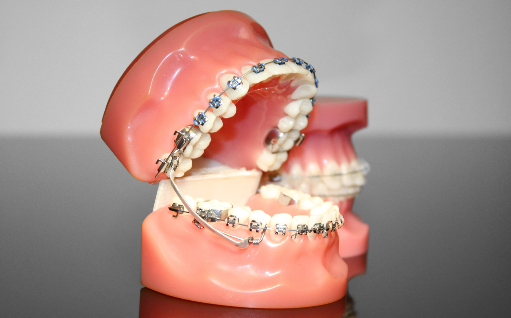 Metallbrackets Metallbrackets