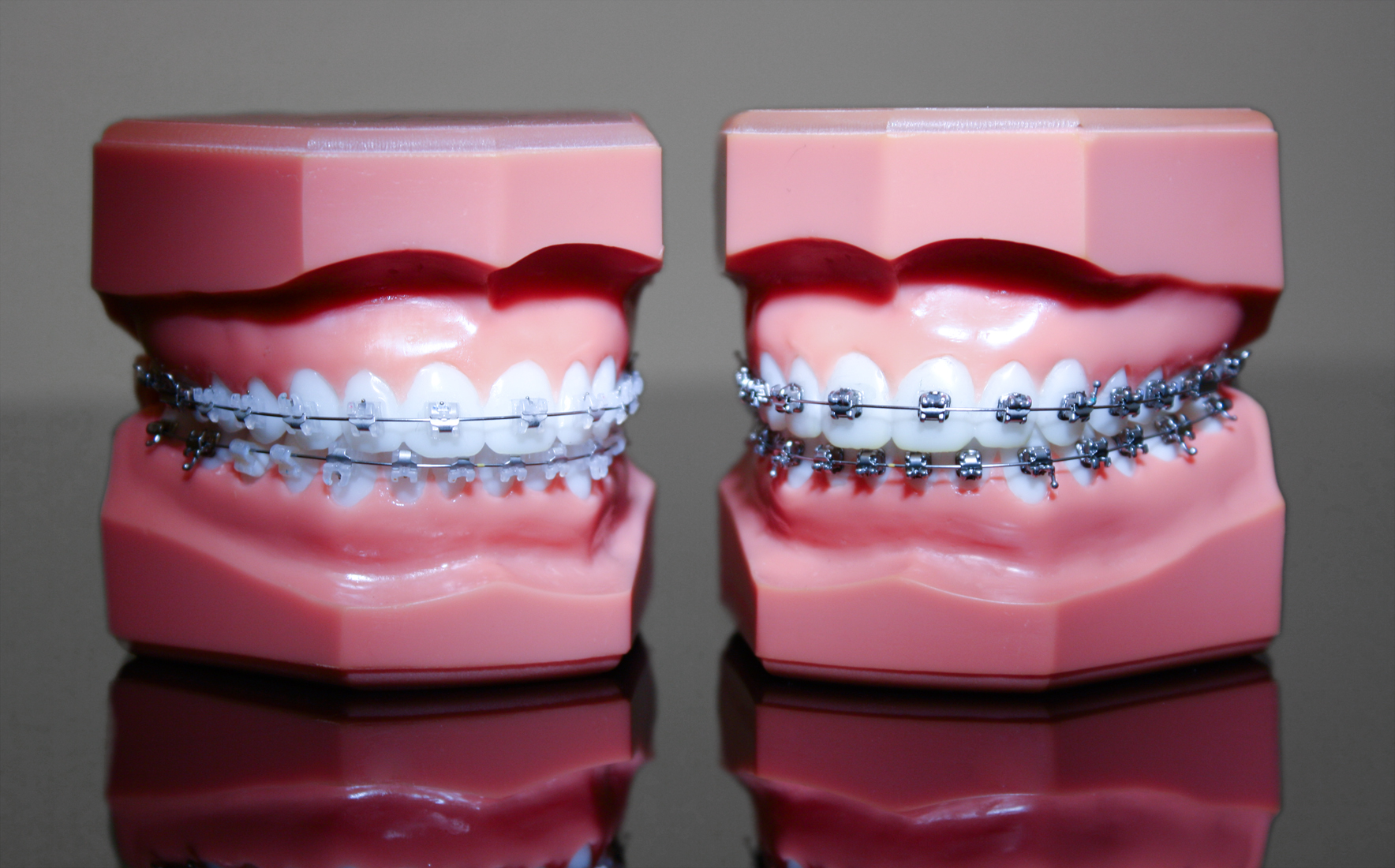 Festsitzende Zahnspangen: Selbstligierende Brackets aus Keramik und Metall Festsitzende Zahnspangen: Selbstligierende Brackets aus Keramik und Metall