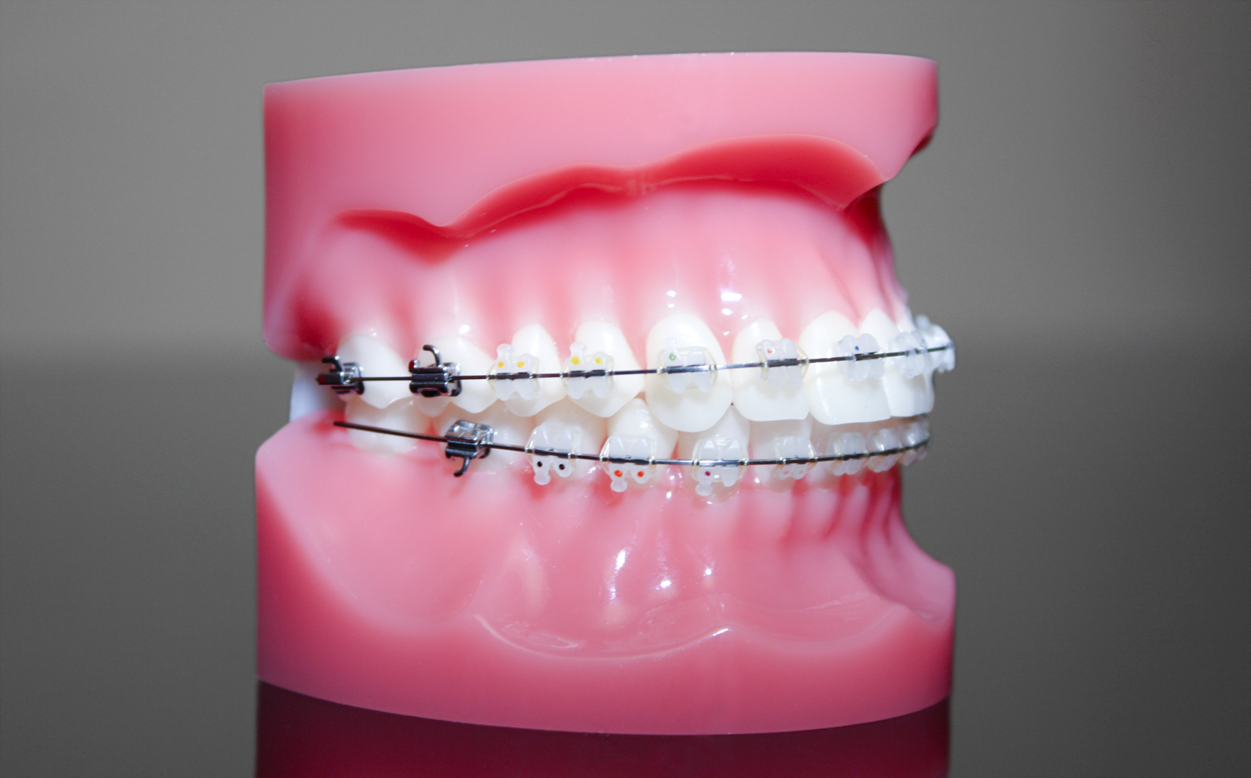 Keramikbrackets Keramikbrackets