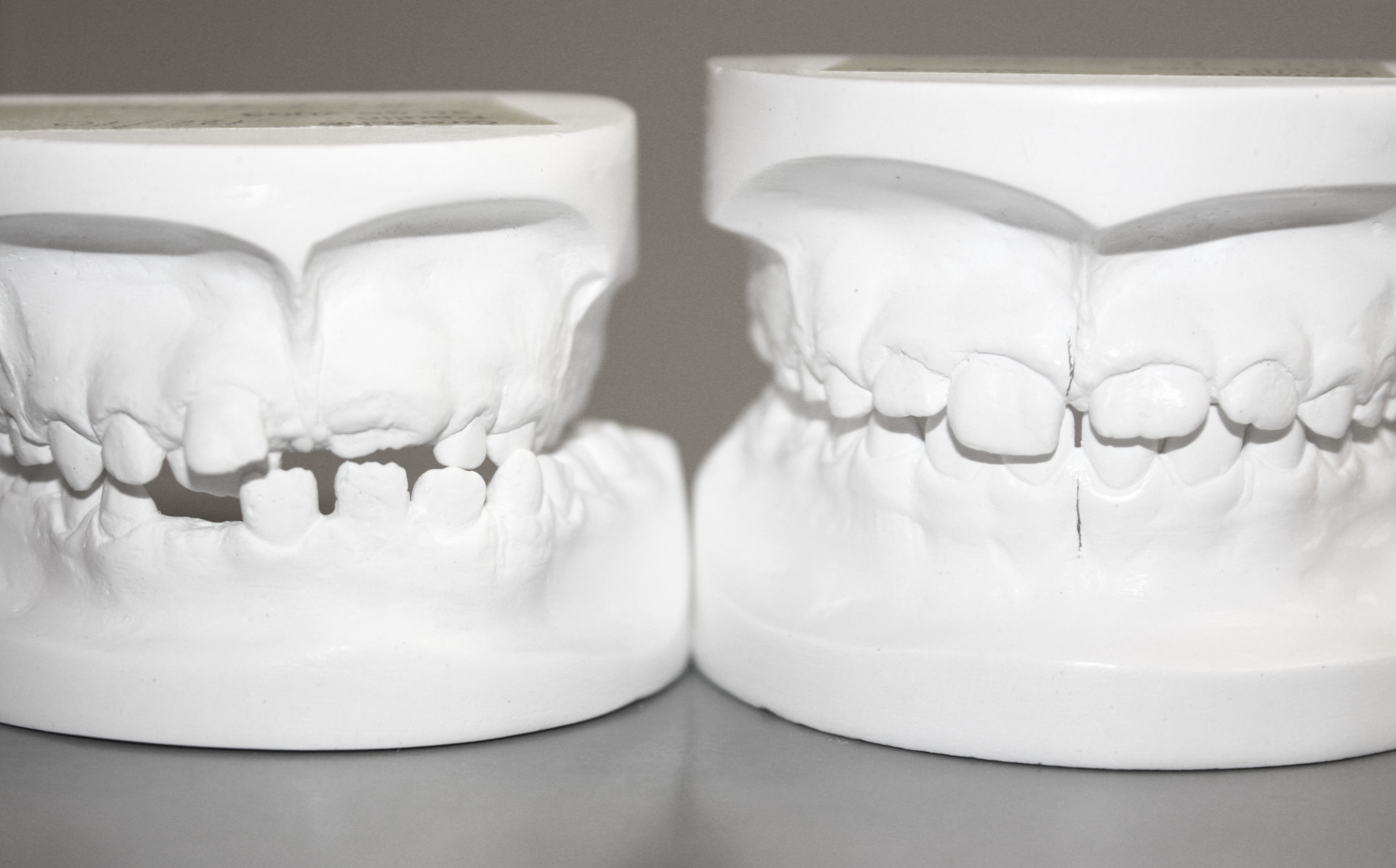 Behandlungsmodelle eines Kindes vor und nach der Behandlung Behandlungsmodelle eines Kindes vor und nach der Behandlung