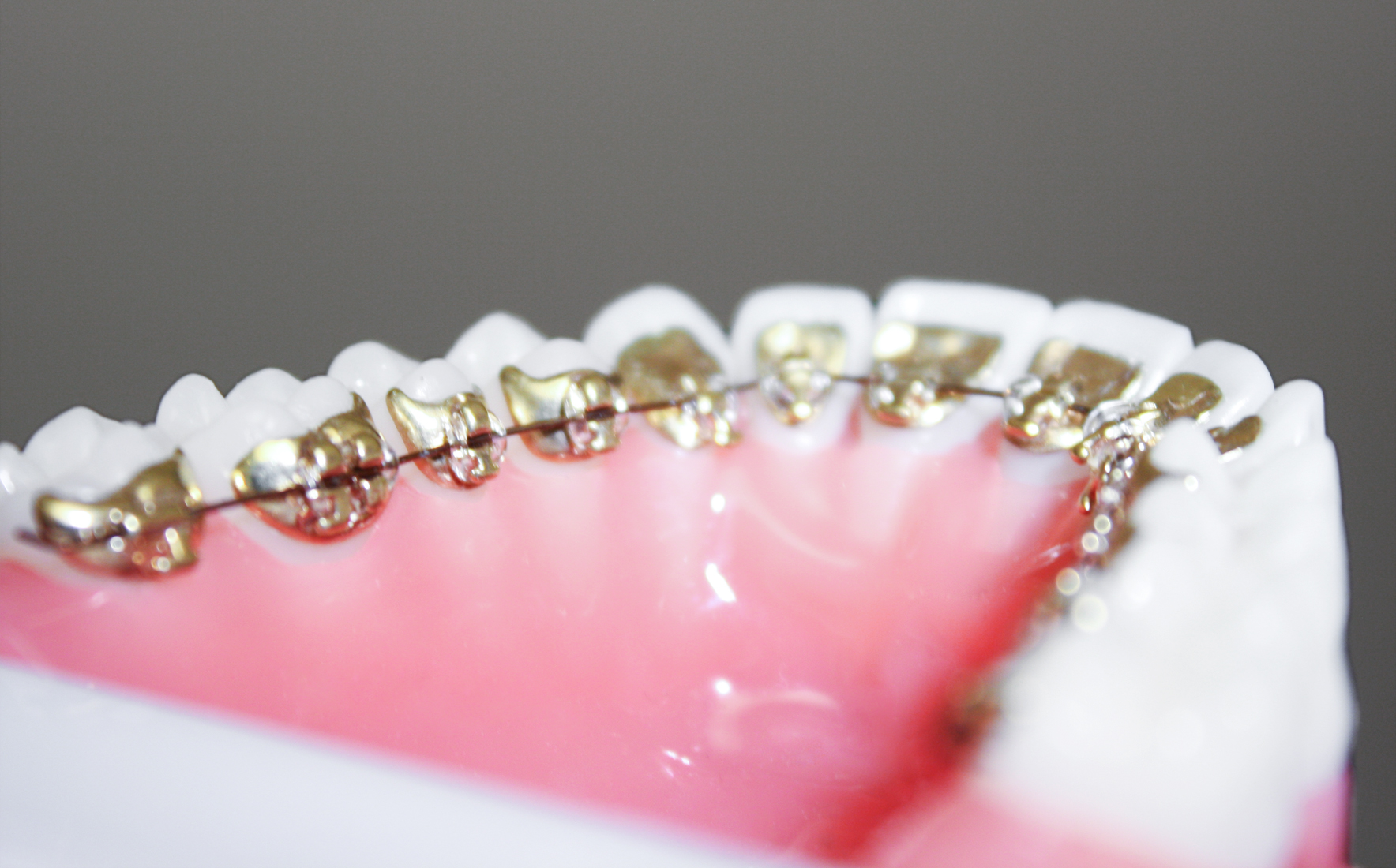 Brackets an der Innenseite des Zahnes Brackets an der Innenseite des Zahnes