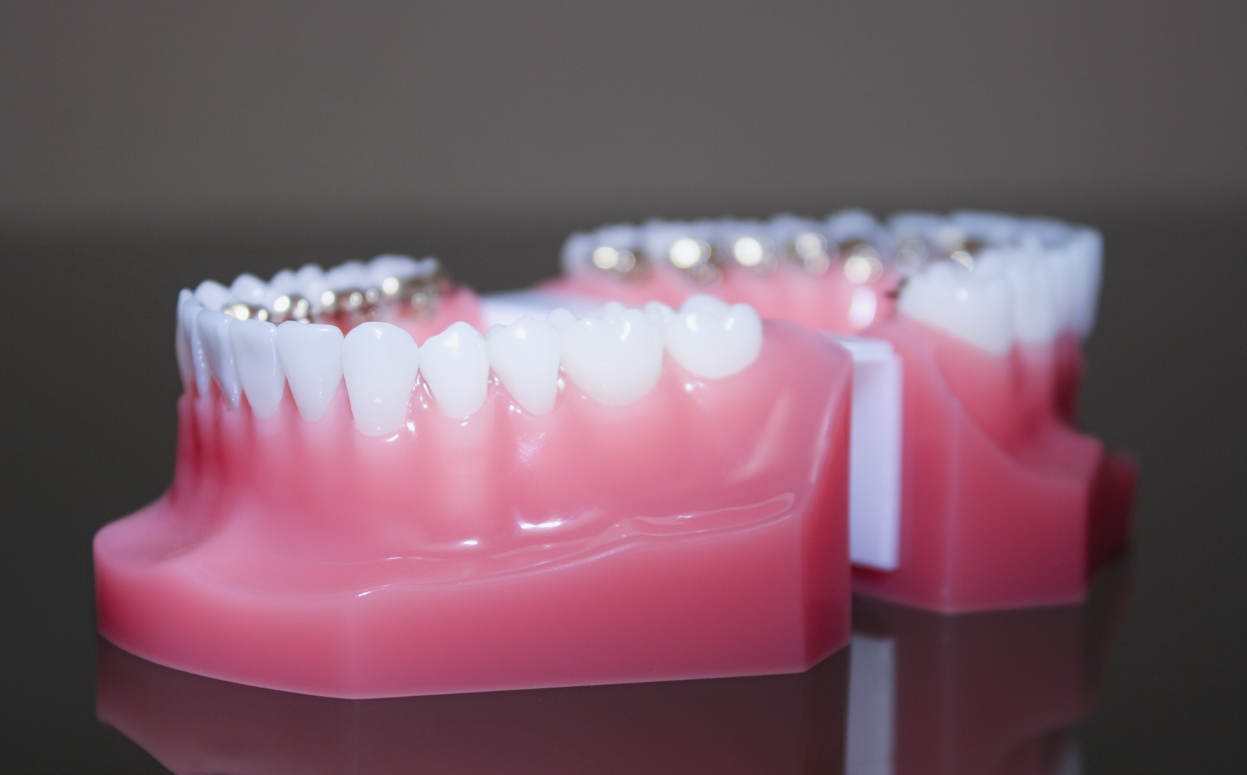 Brackets an der Innenseite des Zahnes Brackets an der Innenseite des Zahnes