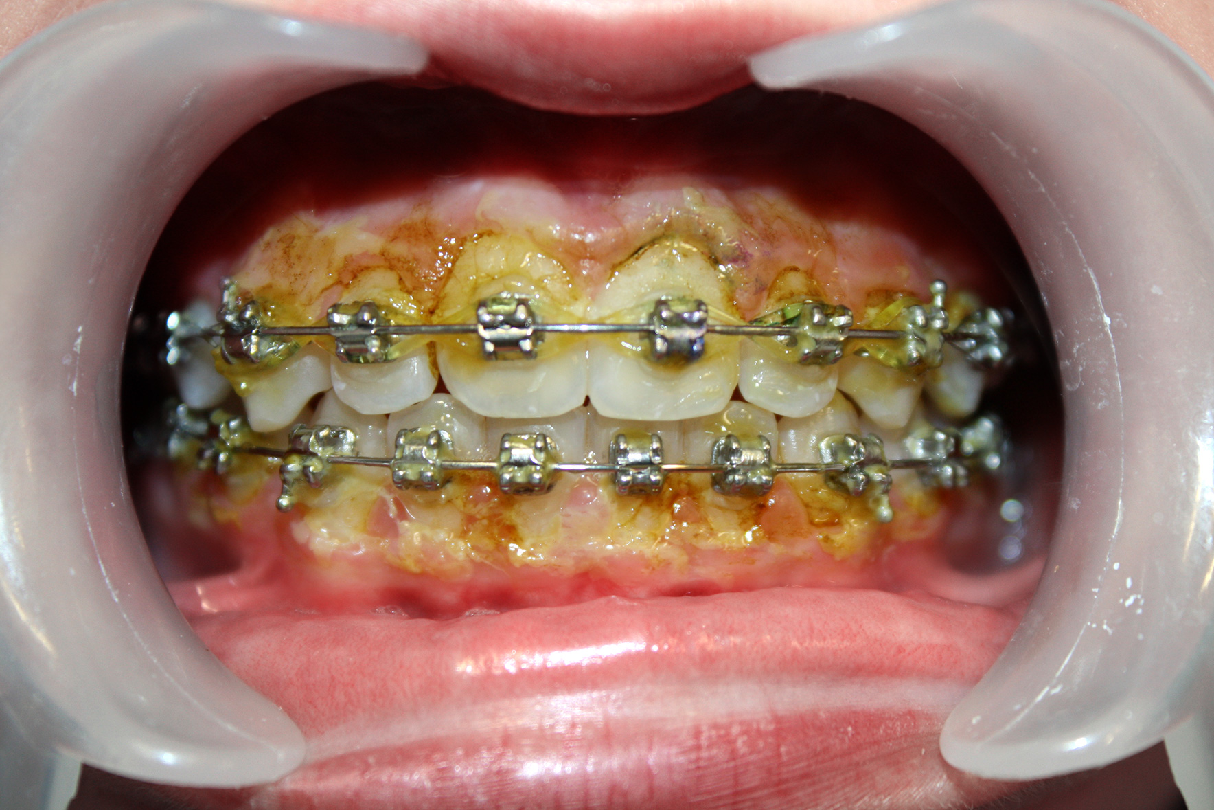 Vorher: Ablagerung von Zahnbelag Vorher: Ablagerung von Zahnbelag